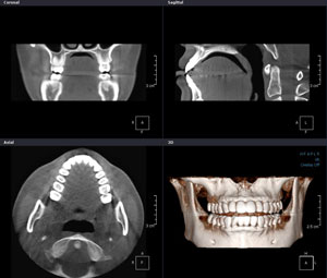 歯科用コーンビーム3D-CT(アサヒAUGE　SOLIO)