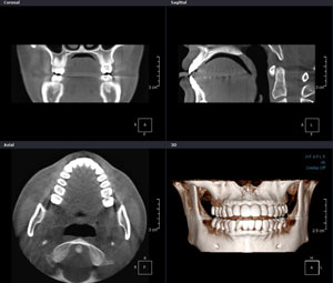 歯科用コーンビーム3D-CT(アサヒAUGE SOLIO)